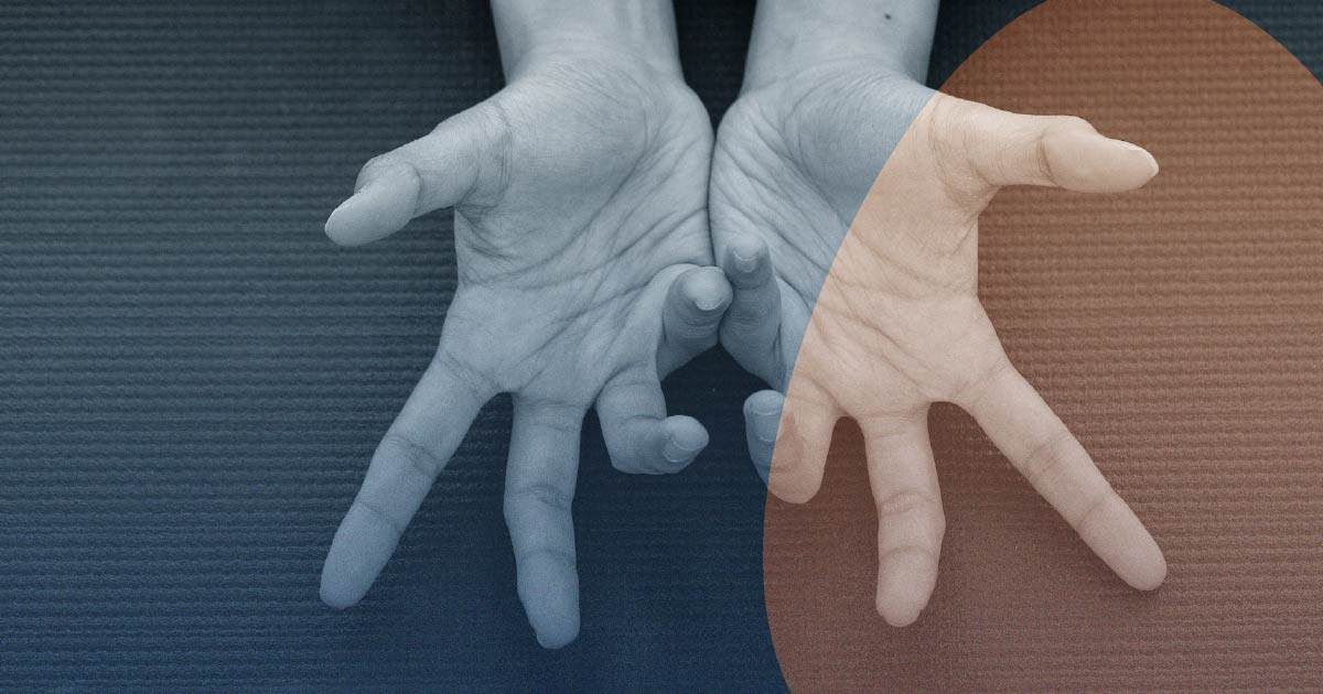Dupuytren contracture (viking curse)