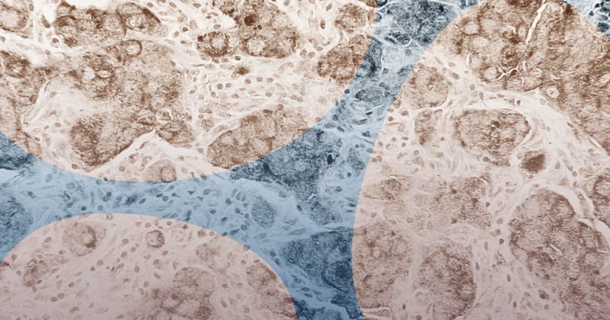 Breast Cancer (Ductal Carcinoma) depiction from the National Cancer Institute for This Medical Life Episode 30