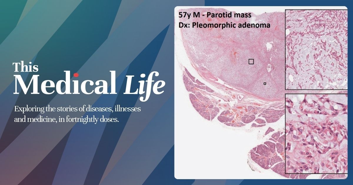 Pleomorphic Adenoma | Mixed Tumours on This Medical Life Podcast with Dr Travis Brown, Steve Davis, and Dr Rowen Valentine